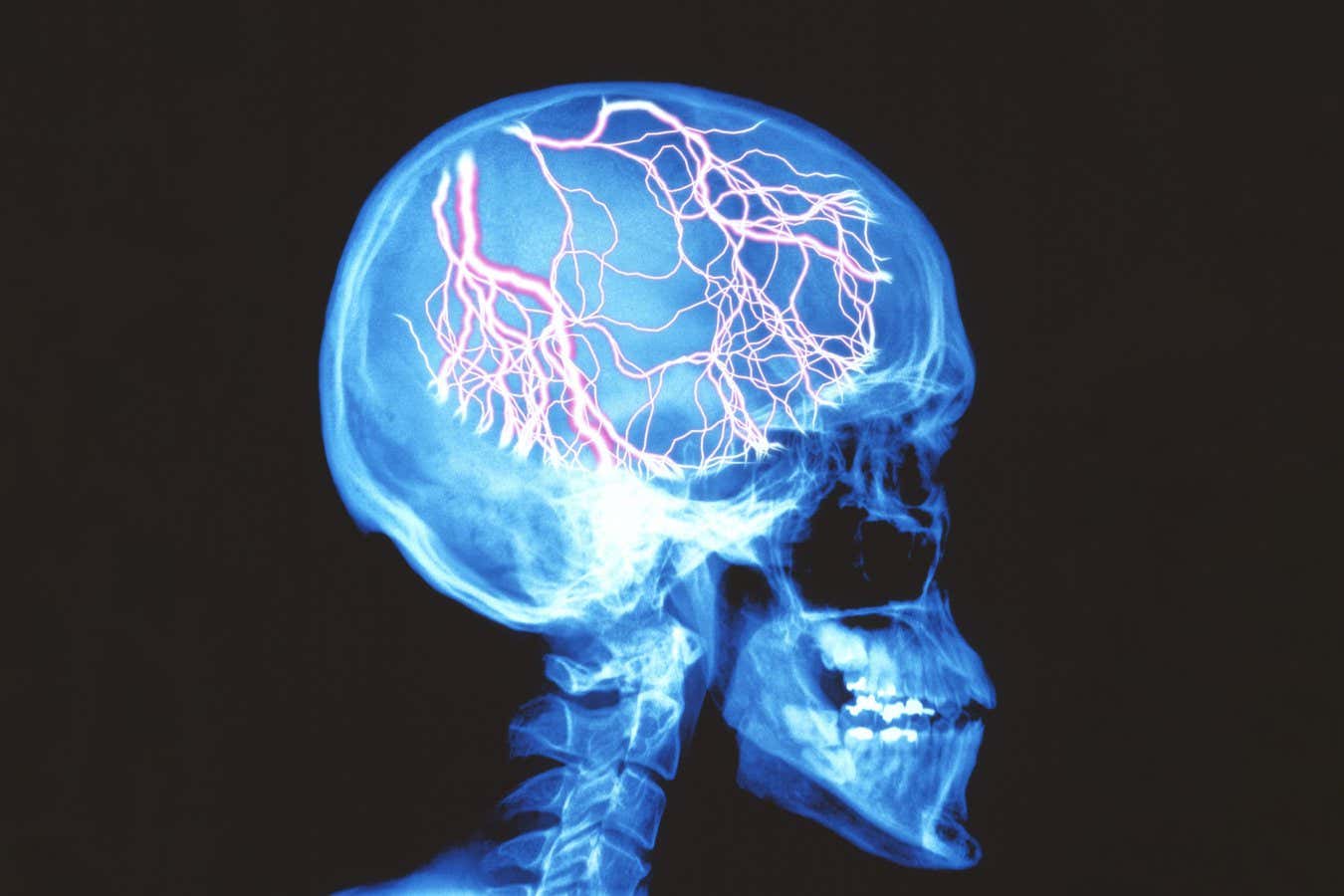 Baş ağrısını tedavi eden migren ilacı, baş dönmesi gibi semptomları da hafifletir
