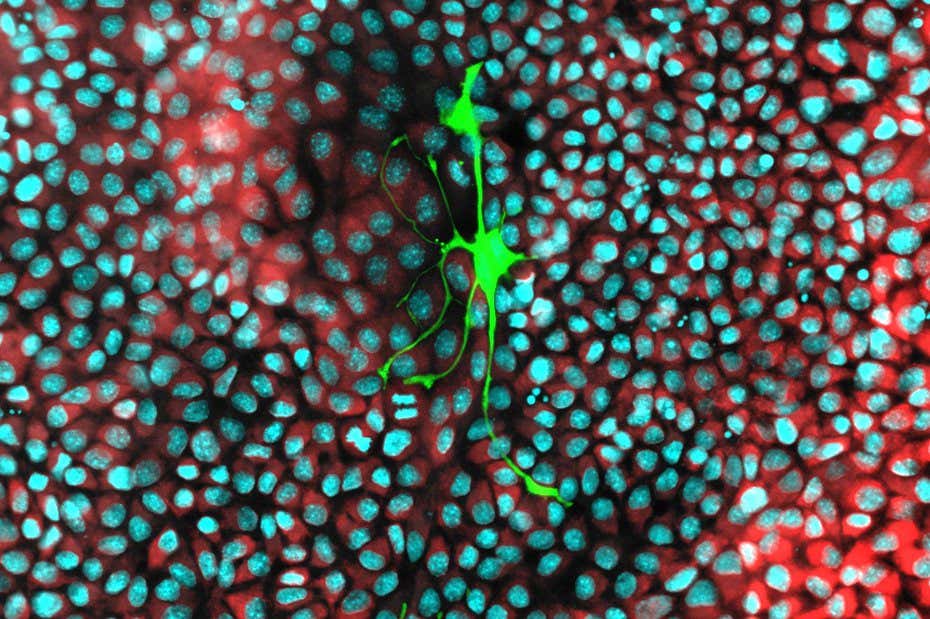 Kanser hücreleri, yayılmalarını beslemek için sinir hücrelerinden mitokondriyi çalar