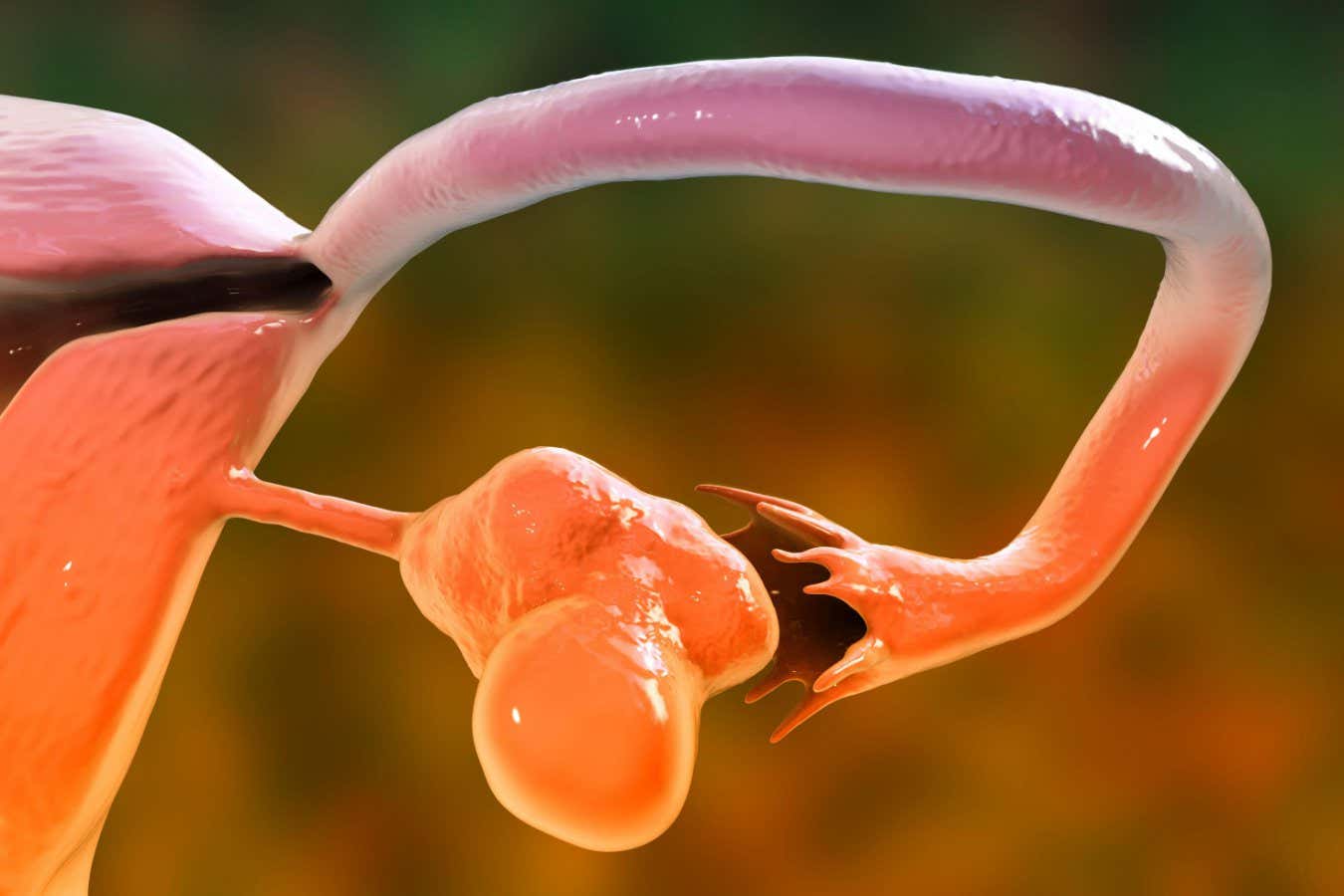 Polikistik yumurtalık sendromu DNA üzerindeki kimyasal etiketler yoluyla aktarılabilir