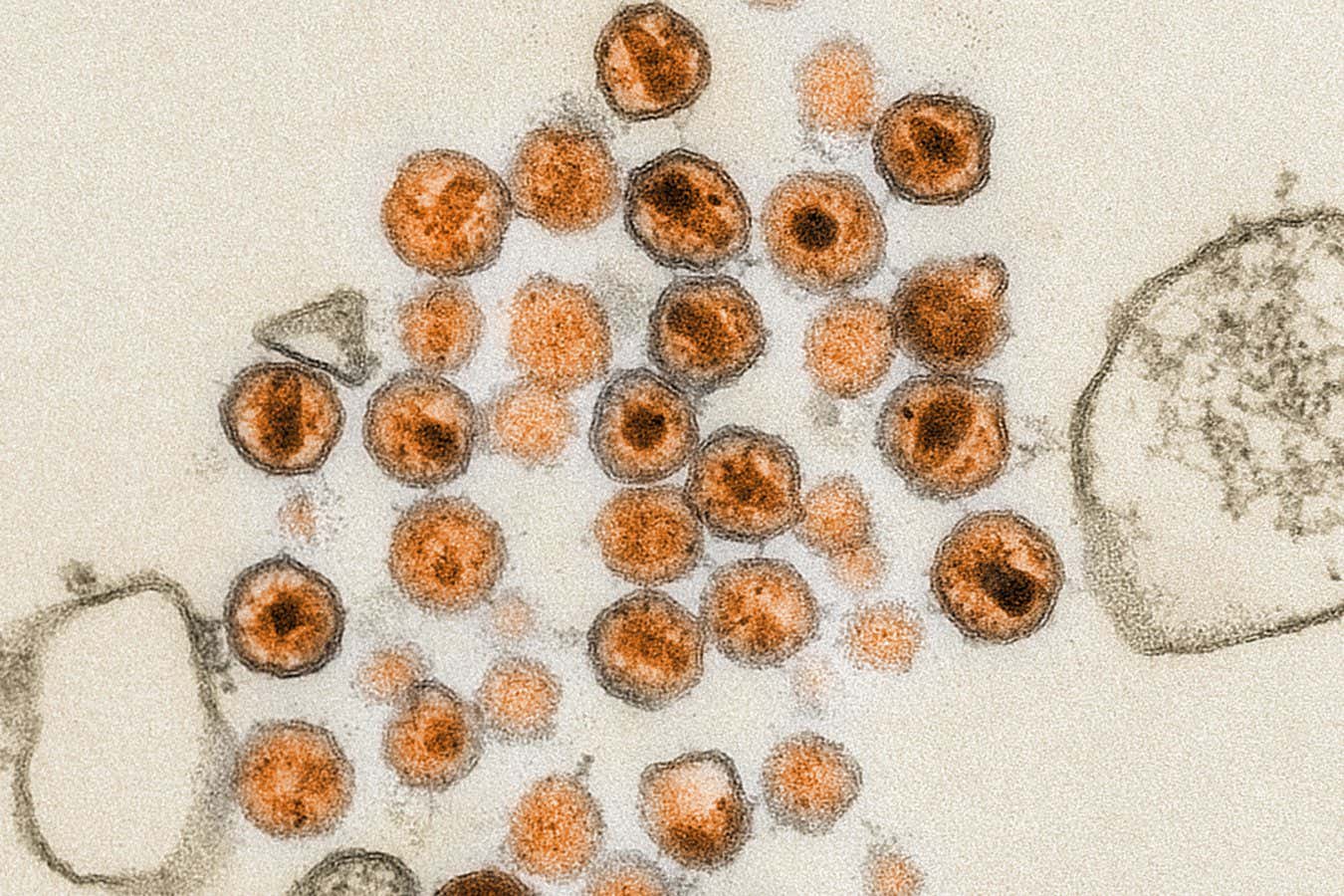 Electron micrograph of the HIV pathogen