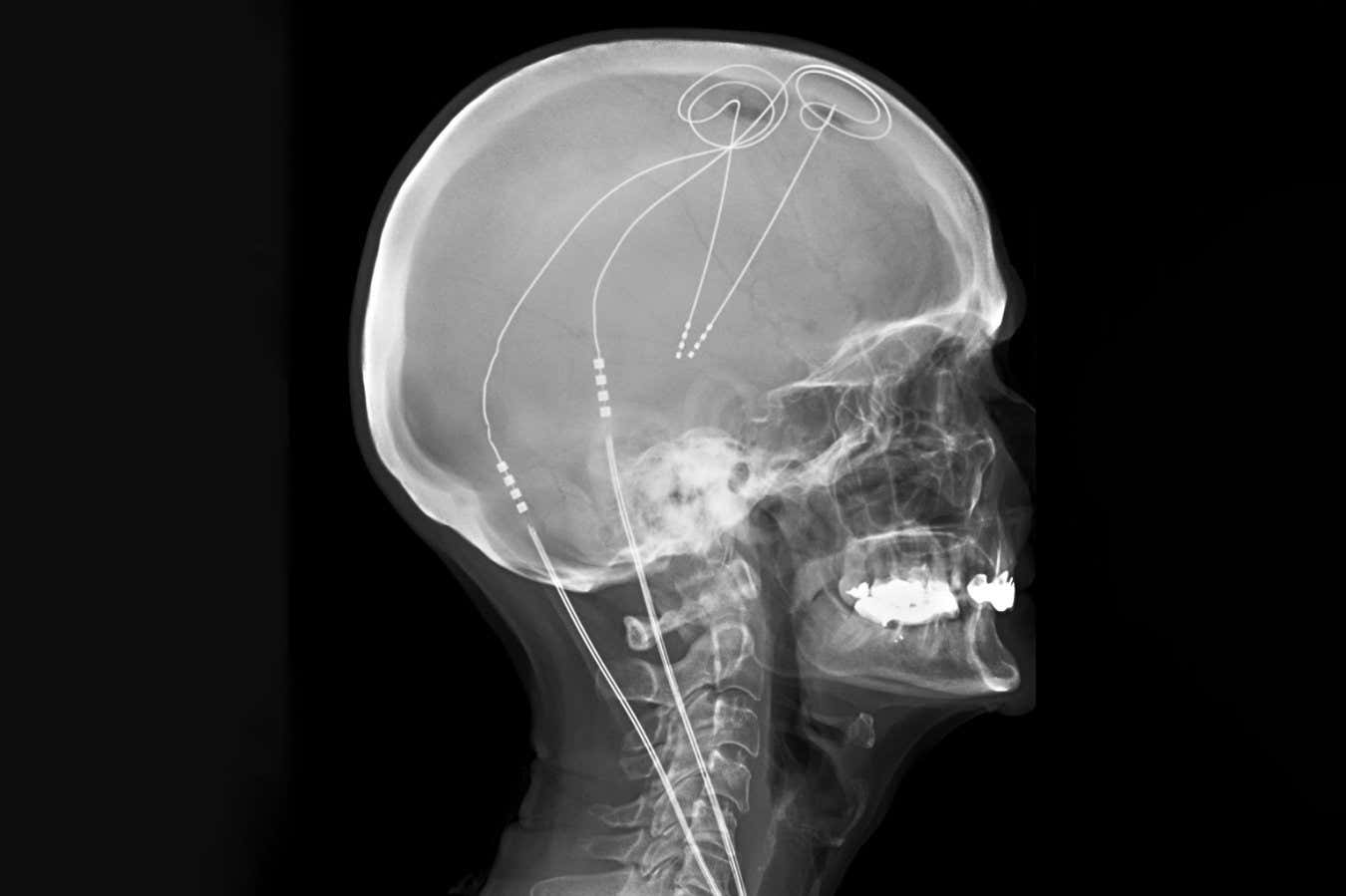 Ismarlama beyin implantı kronik ağrıdan uzun süreli rahatlama sağlar