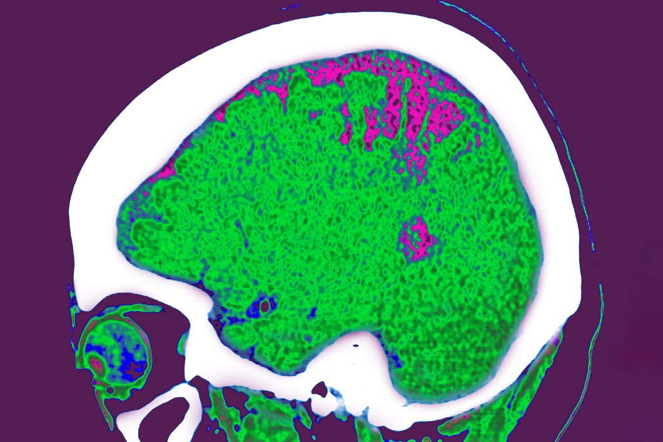Yağ depoladığınız yerde beyniniz üzerindeki etkisini etkileyebilir