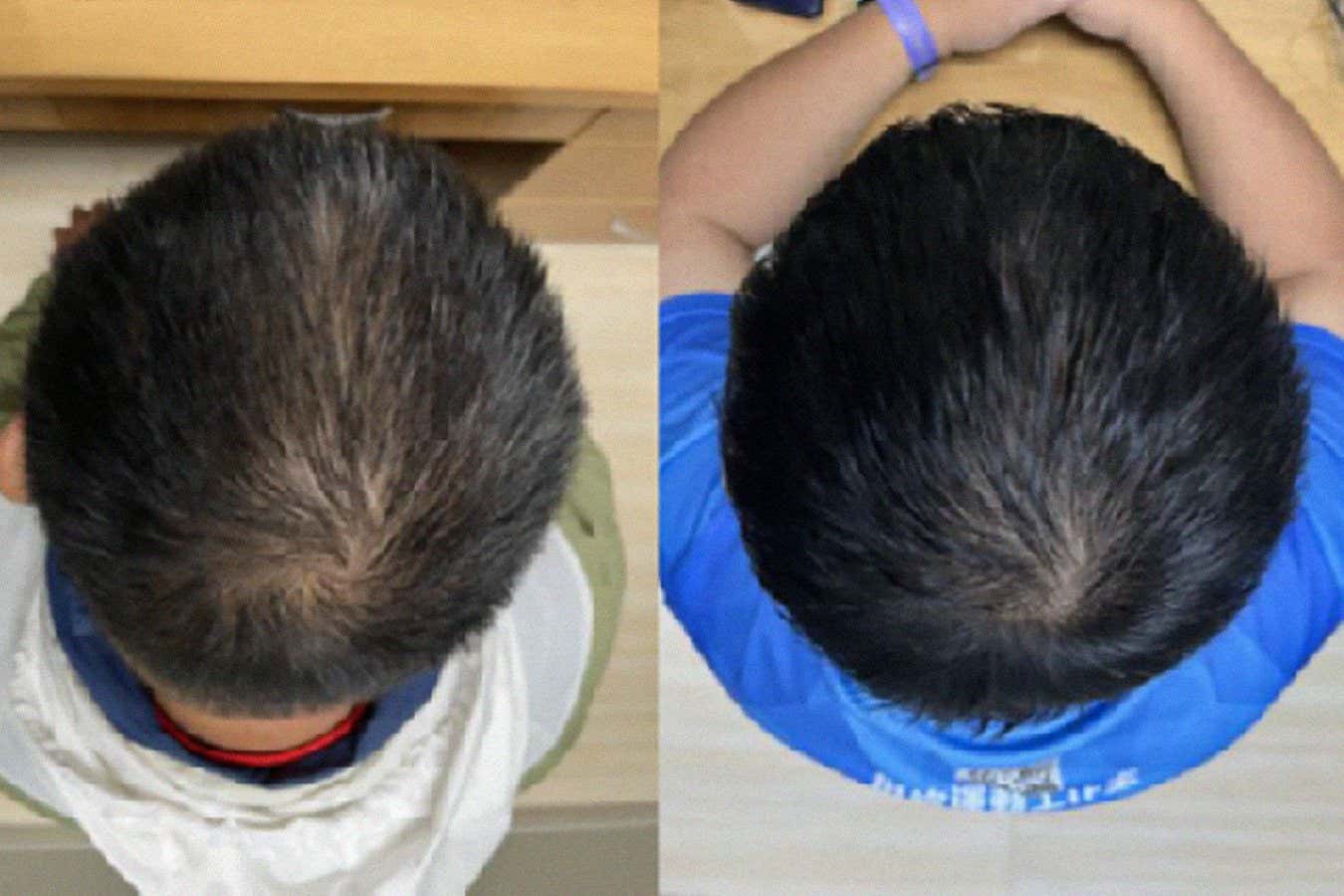 The improvement in hair growth after 56 days of using the serum